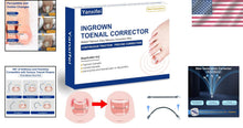 Load image into Gallery viewer, Nitinol Ingrown Toenail Corrector Kit - Fast Relief &amp; Shape Change in 30 Days