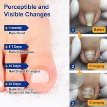 Load image into Gallery viewer, Nitinol Ingrown Toenail Corrector Kit - Fast Relief &amp; Shape Change in 30 Days