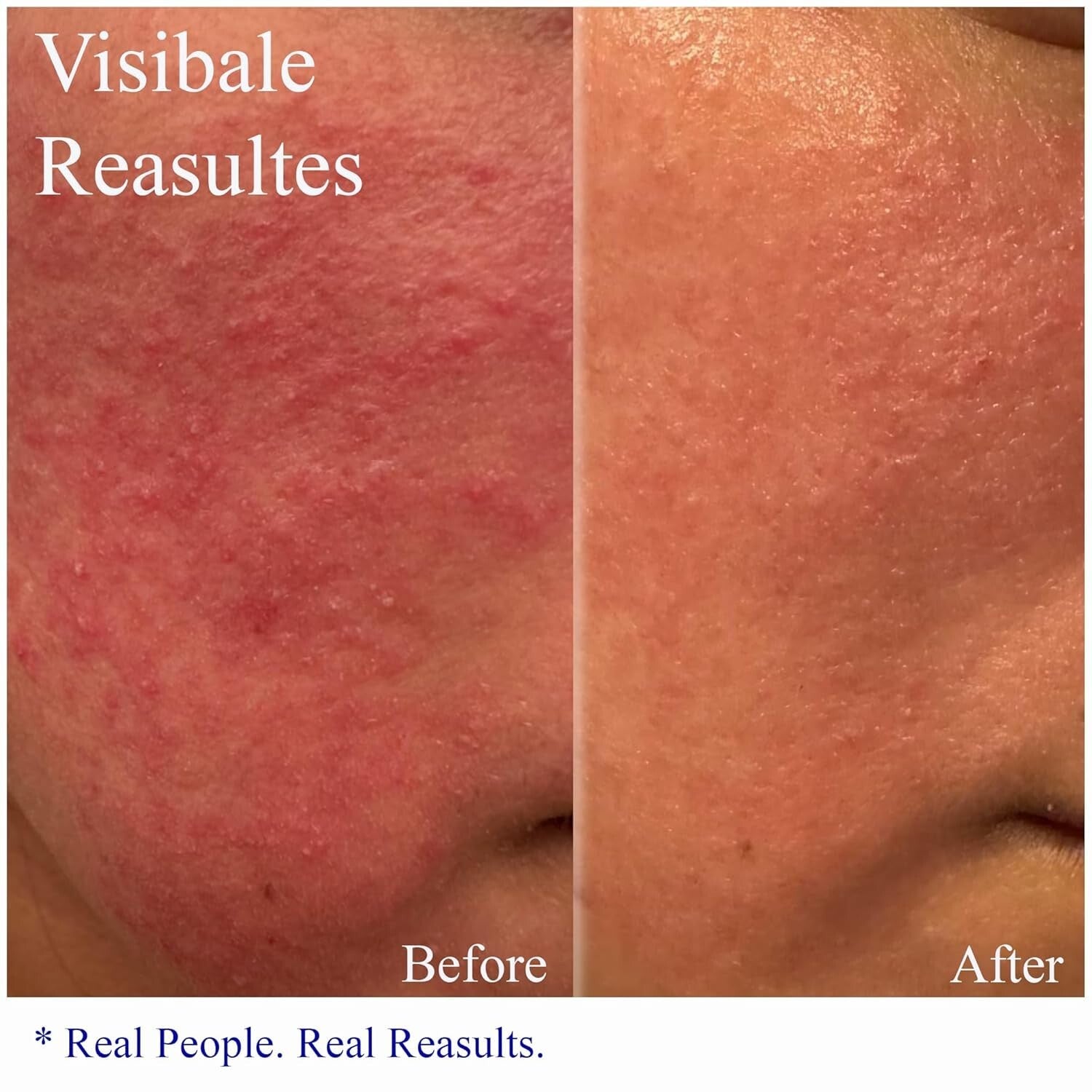 Sensitive Skin Redness Relief Lotion - Fast-Acting, Hypoallergenic & Non-Greasy