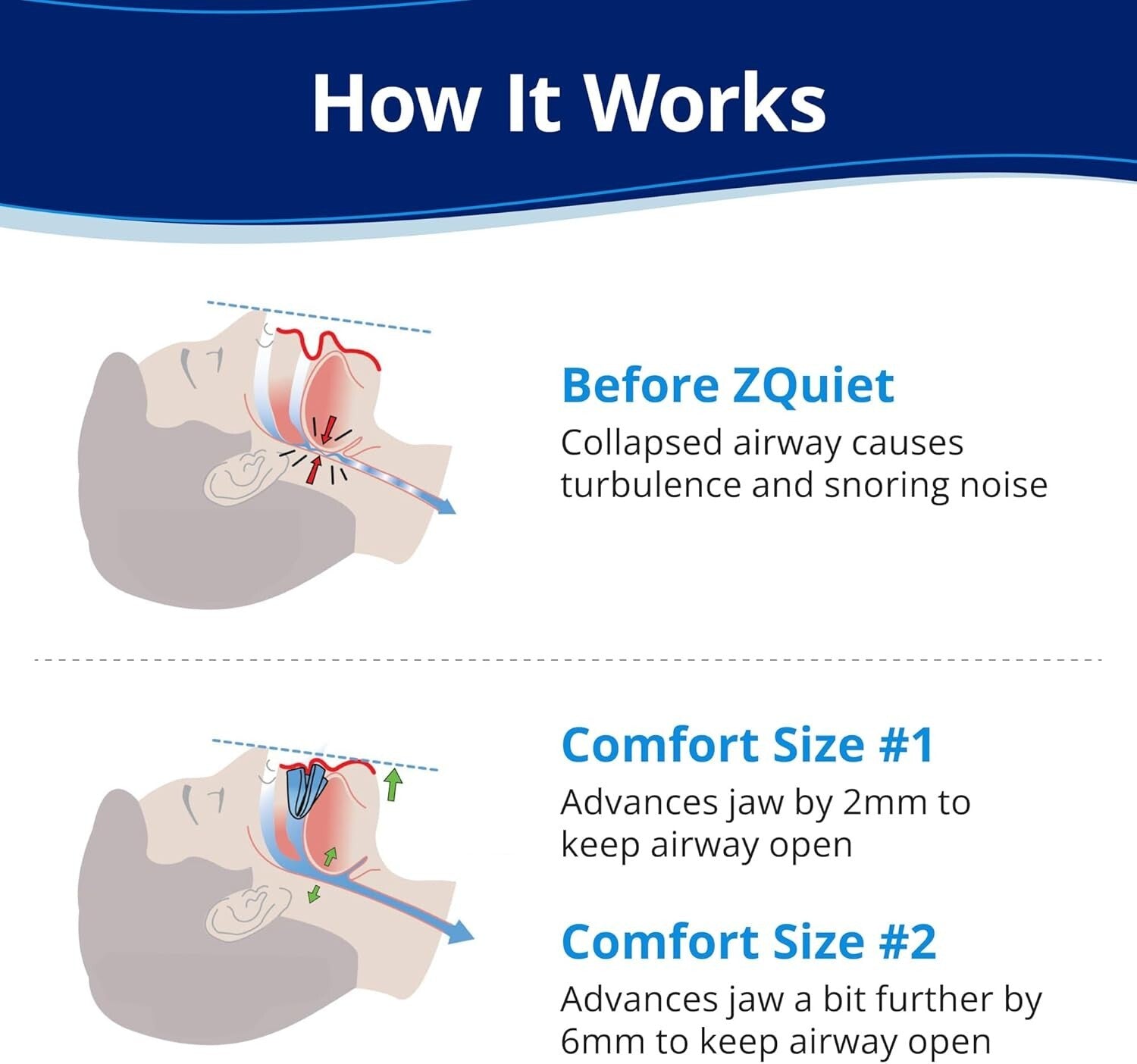 Effective Anti-Snoring Mouthpiece - Flexible Design with Storage Case Included