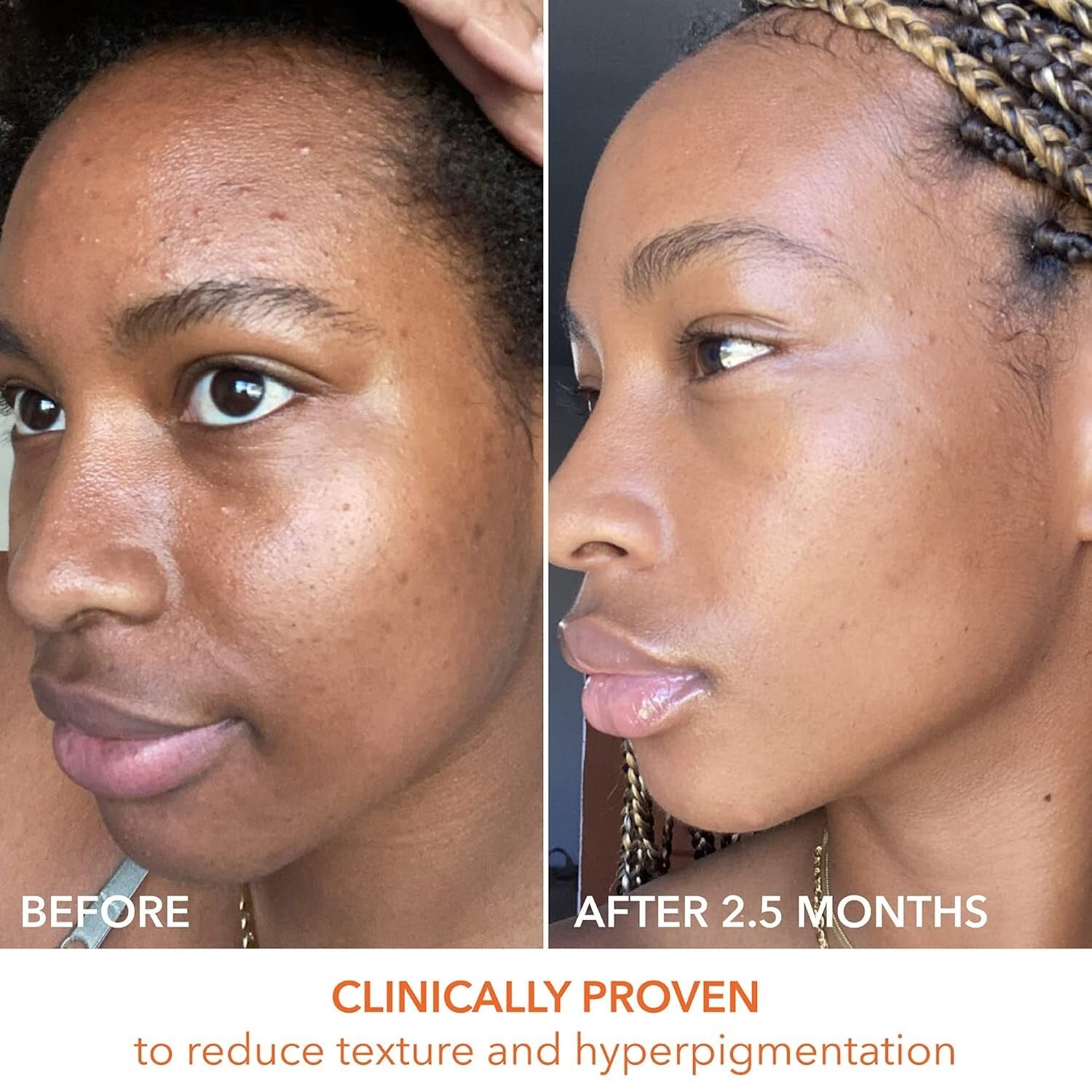 Dr. Dennis Gross Peel Pads - Fast-Acting 2-Step Treatment for Flawless Skin