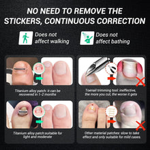 Load image into Gallery viewer, Titanium Alloy Ingrown Toenail Treatment Kit – Patented Nail Correction Tools