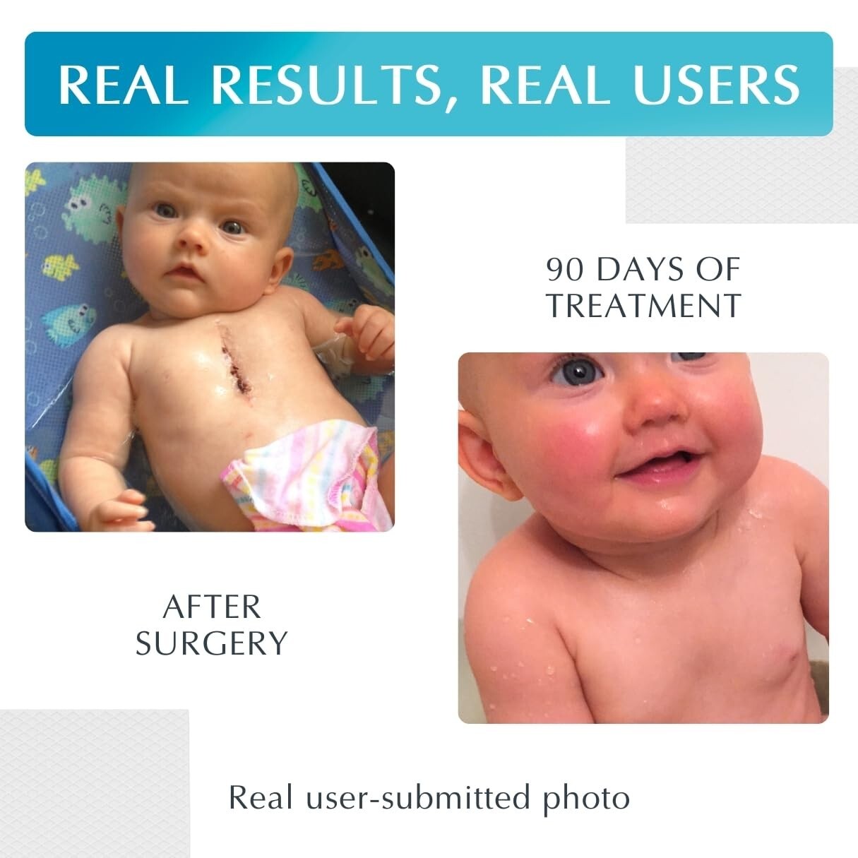 Advanced Silicone Scar Treatment Sheets - Medical Grade for All Scars, 4 Count