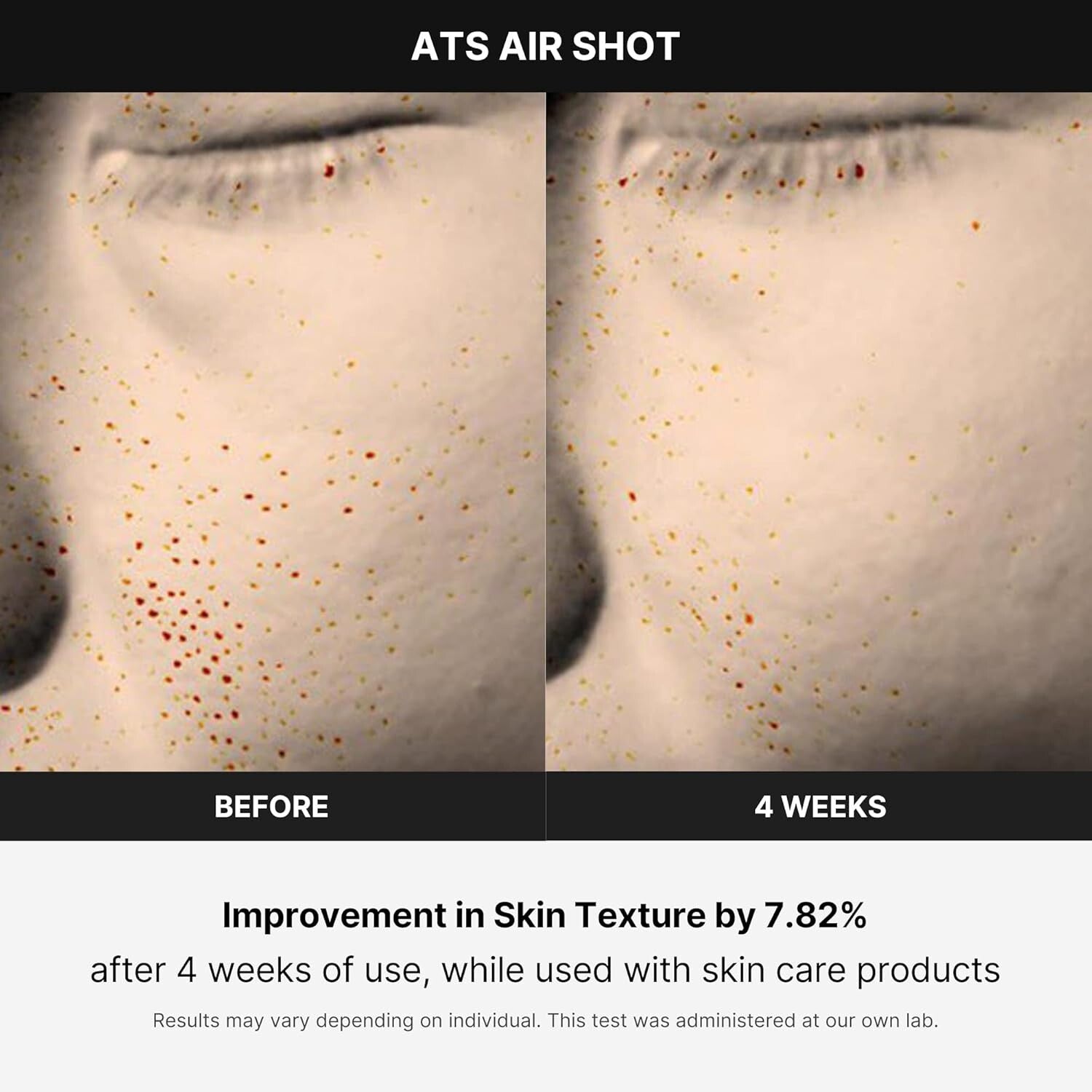 Microneedling Skin Care Device - Age-R ATS Air Shot for Exfoliation & Pore Ti...