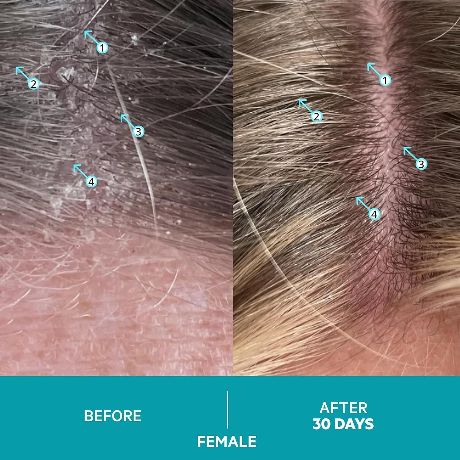 Dandrene Anti-Dandruff Shampoo: Exfoliating Treatment for Itchy Scalp Relief