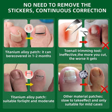 Load image into Gallery viewer, Ingrown Toenail Correction Kit - 10 Titanium Alloy Tools for Fast Pain Relief