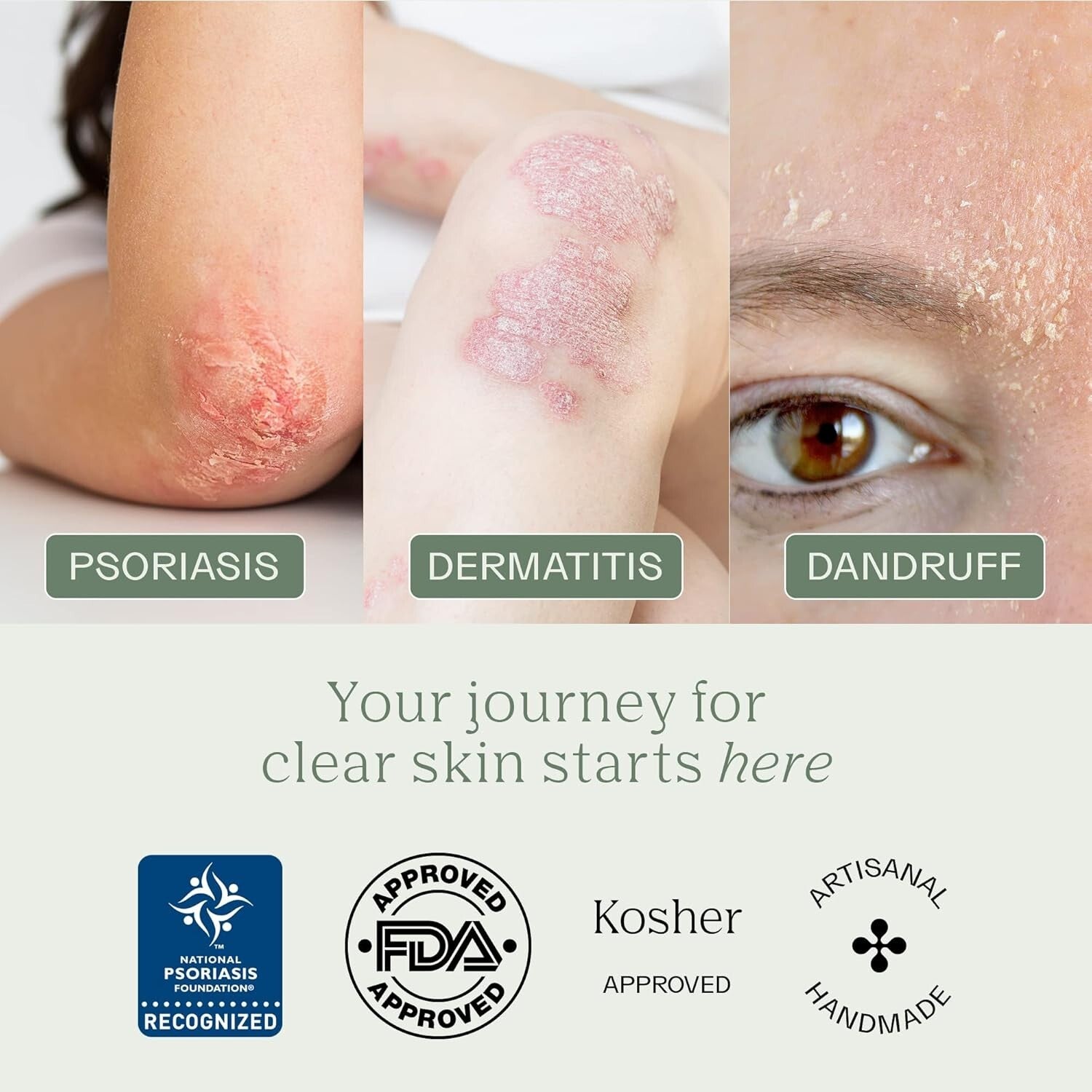 2% Coal Tar Soap - Gentle Cleanser for Psoriasis, Eczema & Sensitive Skin