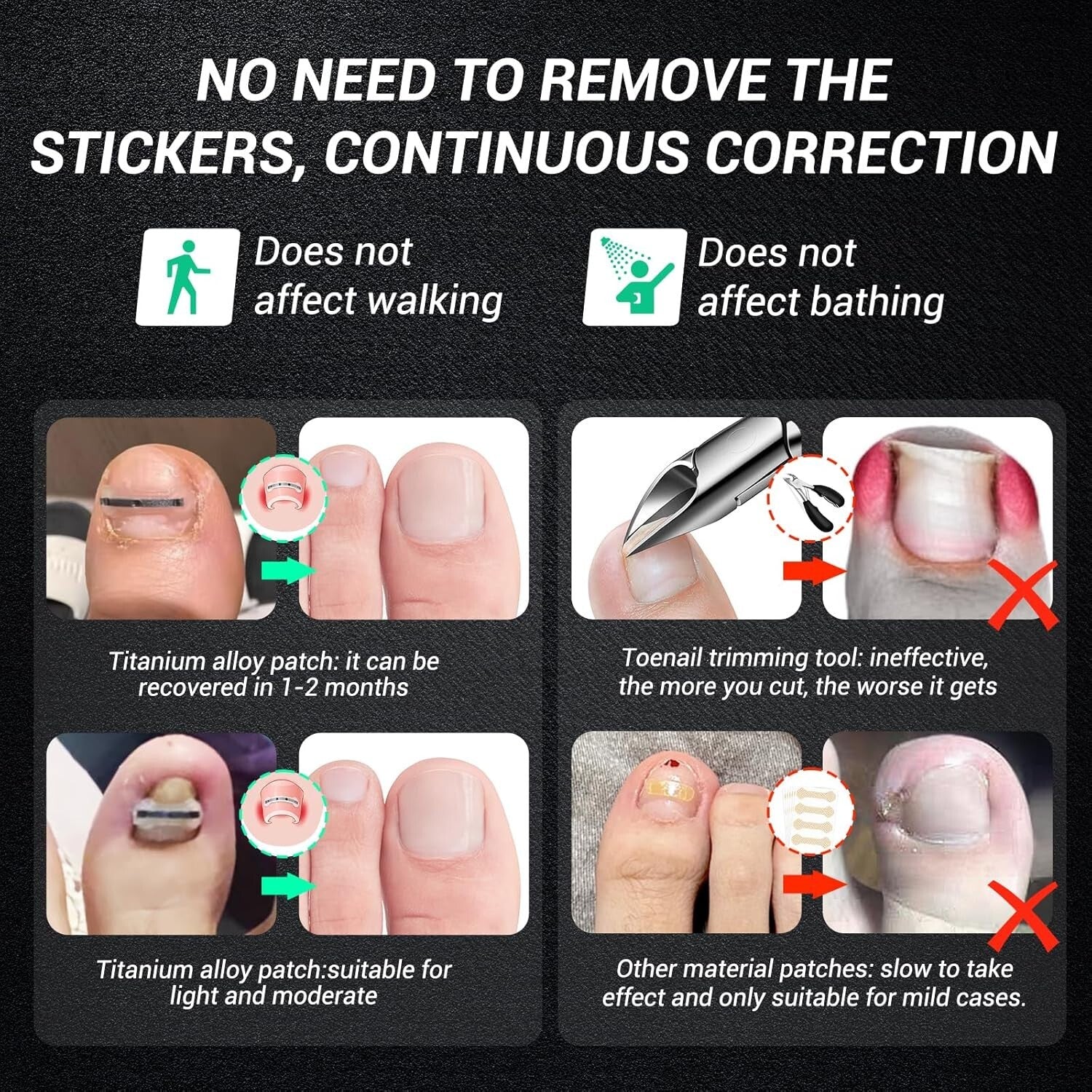 Advanced Ingrown Toenail Removal Kit with 5th Gen Titanium Alloy Technology