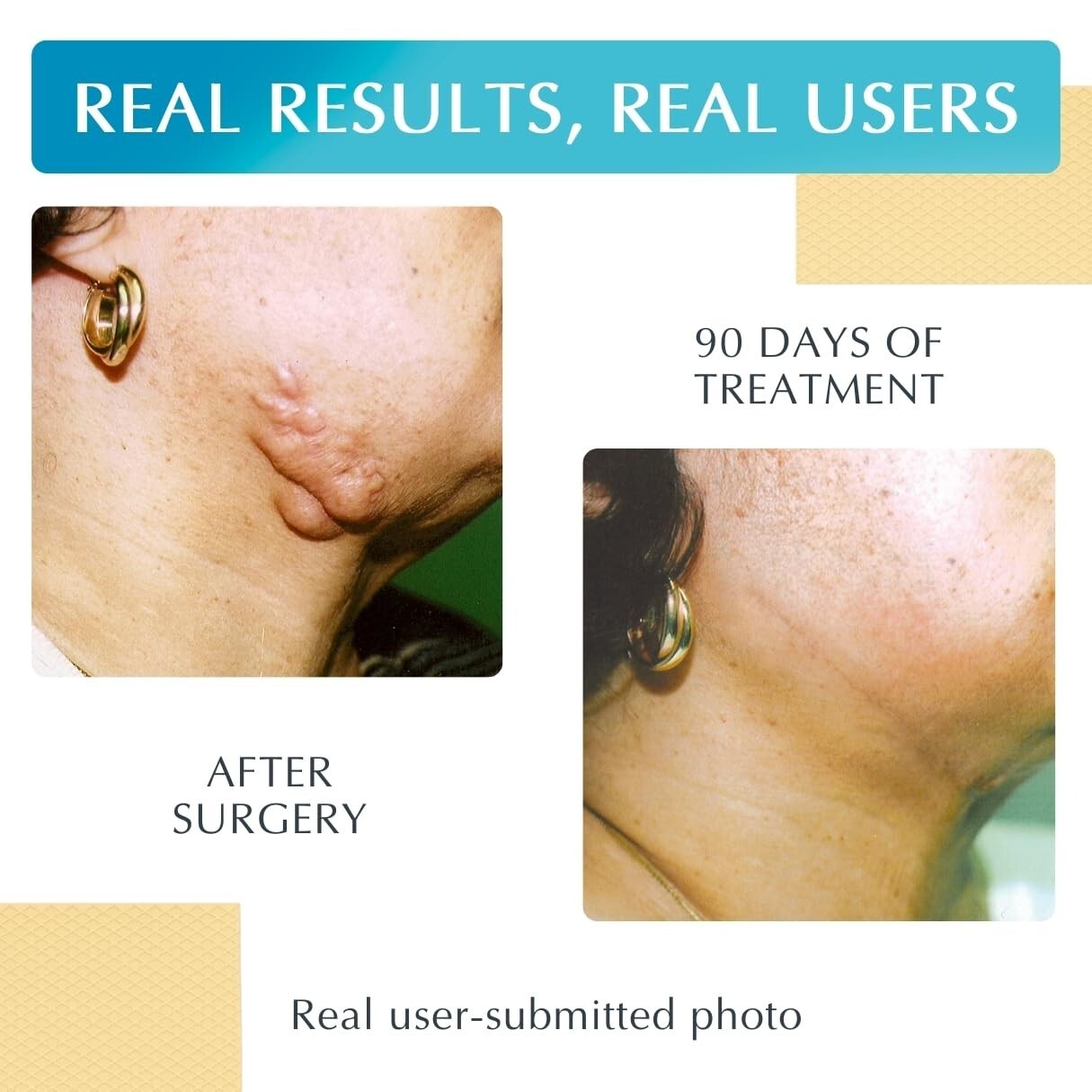 NewGel Plus 1" x 6" Silicone Scar Sheets - Effective for Old and New Scars