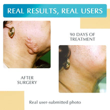 Load image into Gallery viewer, NewGel Plus 1" x 6" Silicone Scar Sheets - Effective for Old and New Scars