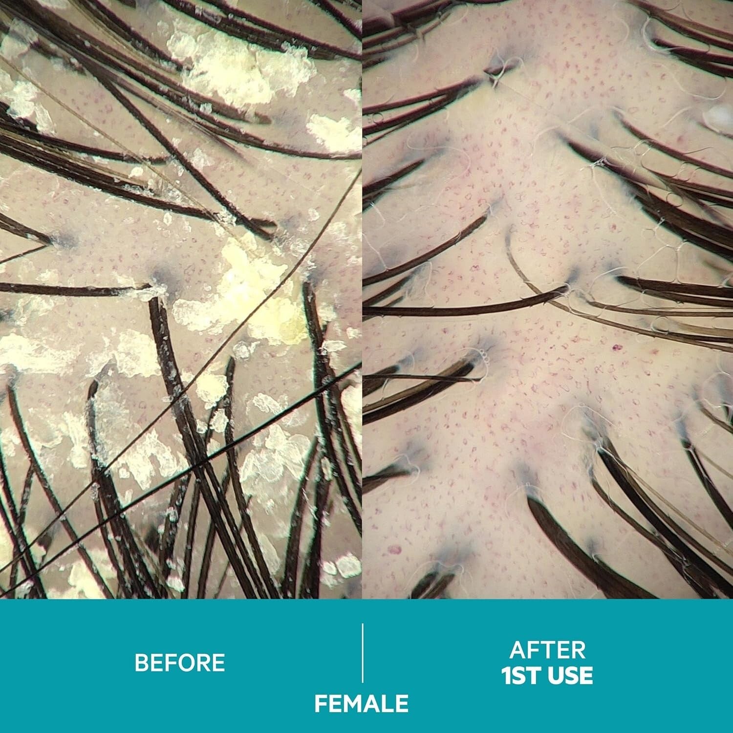 Dandrene Anti-Dandruff Shampoo: Exfoliating Treatment for Itchy Scalp Relief