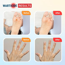 Load image into Gallery viewer, Natural Essential Oil Wart Remover - Safe for Plantar &amp; Genital Warts, 3 Bottles