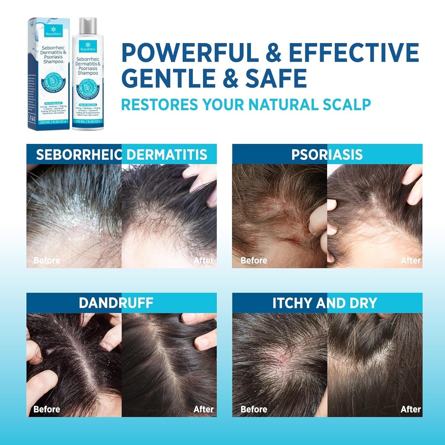 Seborrheic Dermatitis Relief Set - Cream, Shampoo & Conditioner for Scalp Care