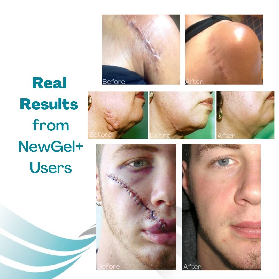 NewGel Plus 1" x 6" Silicone Scar Sheets - Effective for Old and New Scars