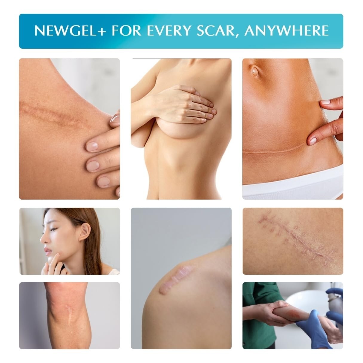 Advanced Silicone Scar Treatment Sheets - Medical Grade for All Scars, 4 Count