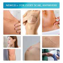Load image into Gallery viewer, Advanced Silicone Scar Treatment Sheets - Medical Grade for All Scars, 4 Count