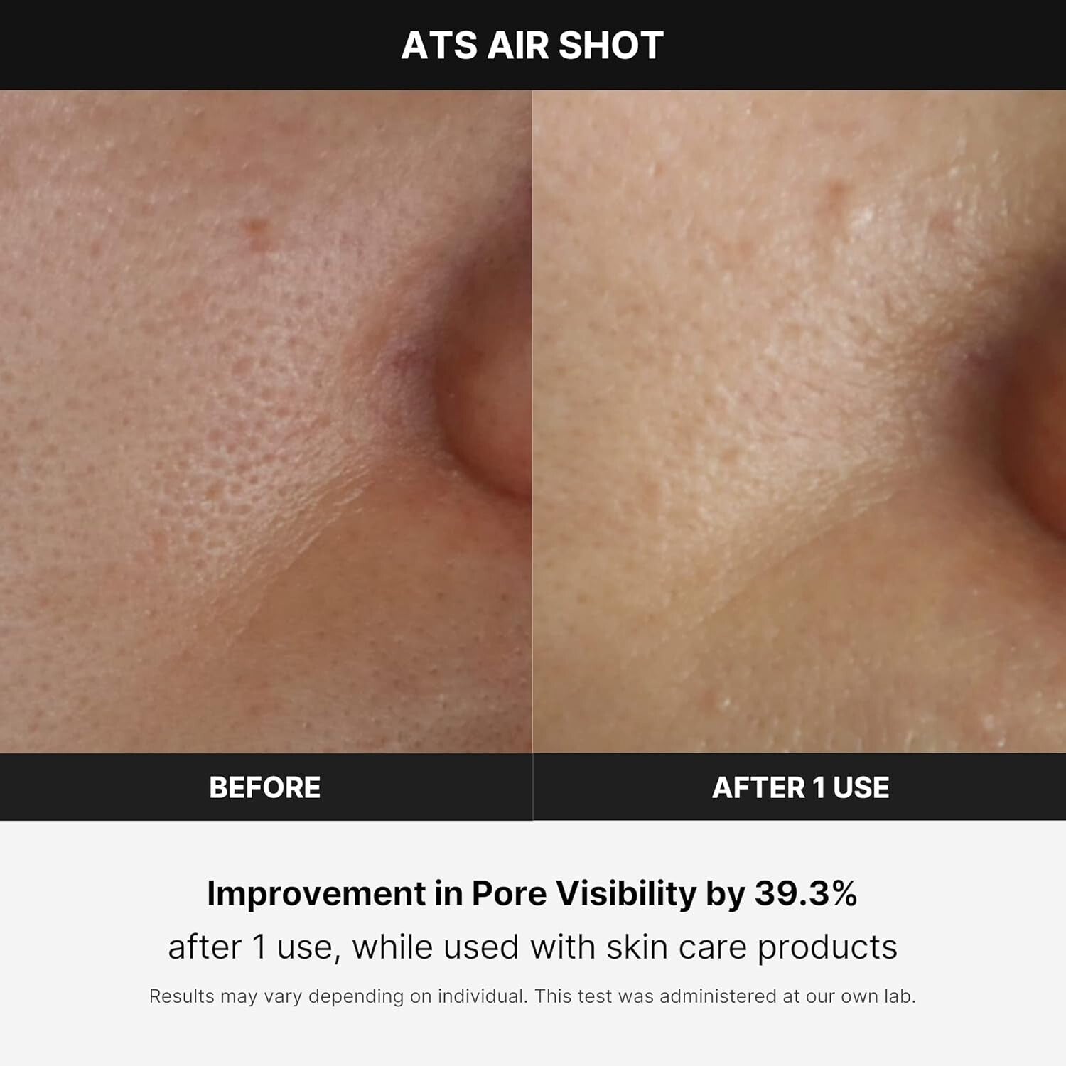 Microneedling Skin Care Device - Age-R ATS Air Shot for Exfoliation & Pore Ti...