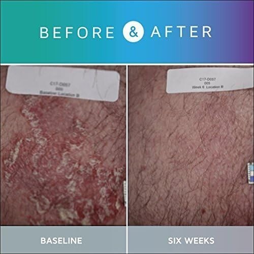 Dual Action Psoriasis Relief - 4 Bottles of Clinical Strength Exfoliating Care