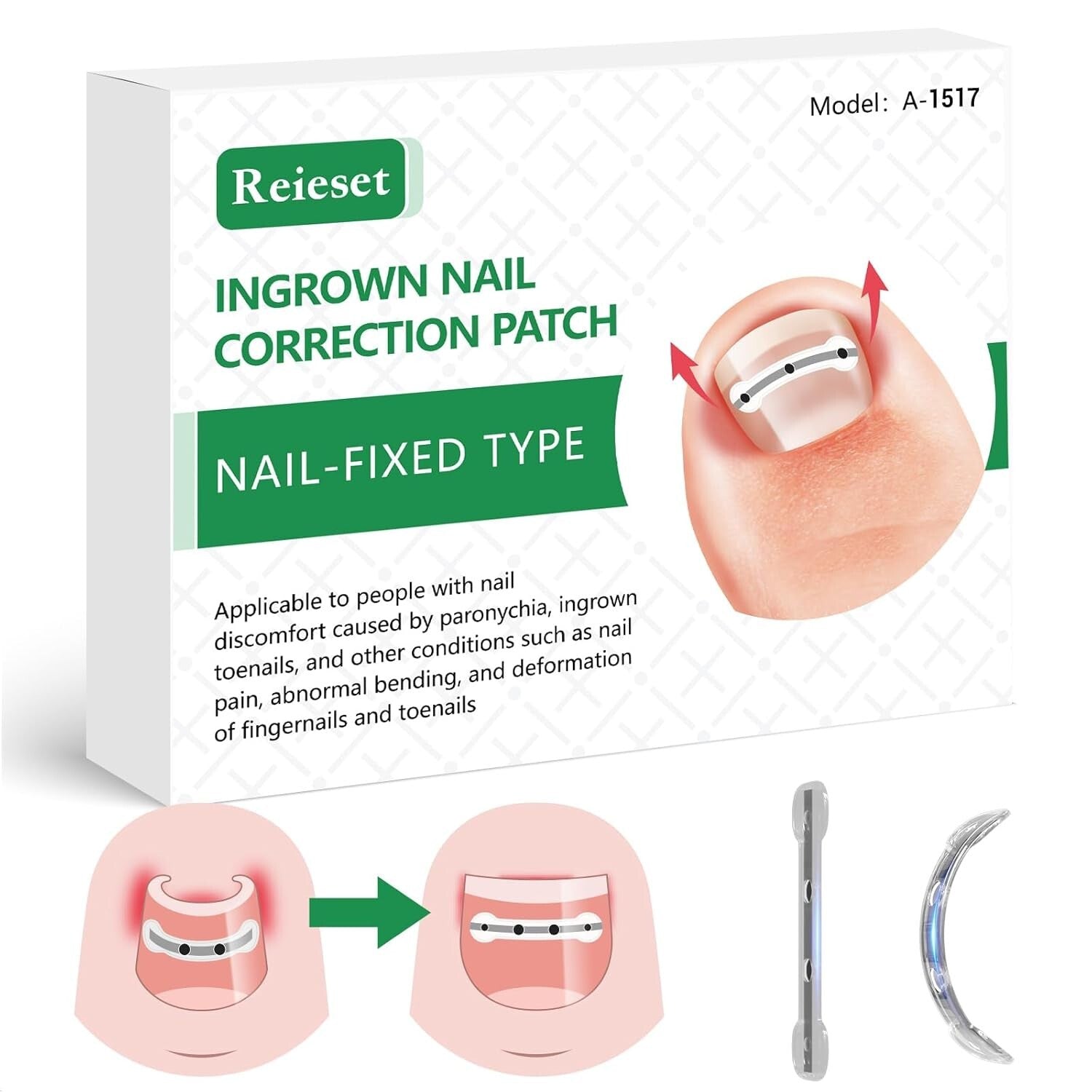 Advanced Ingrown Toenail Treatment Kit – Titanium Alloy Solution for All Nails
