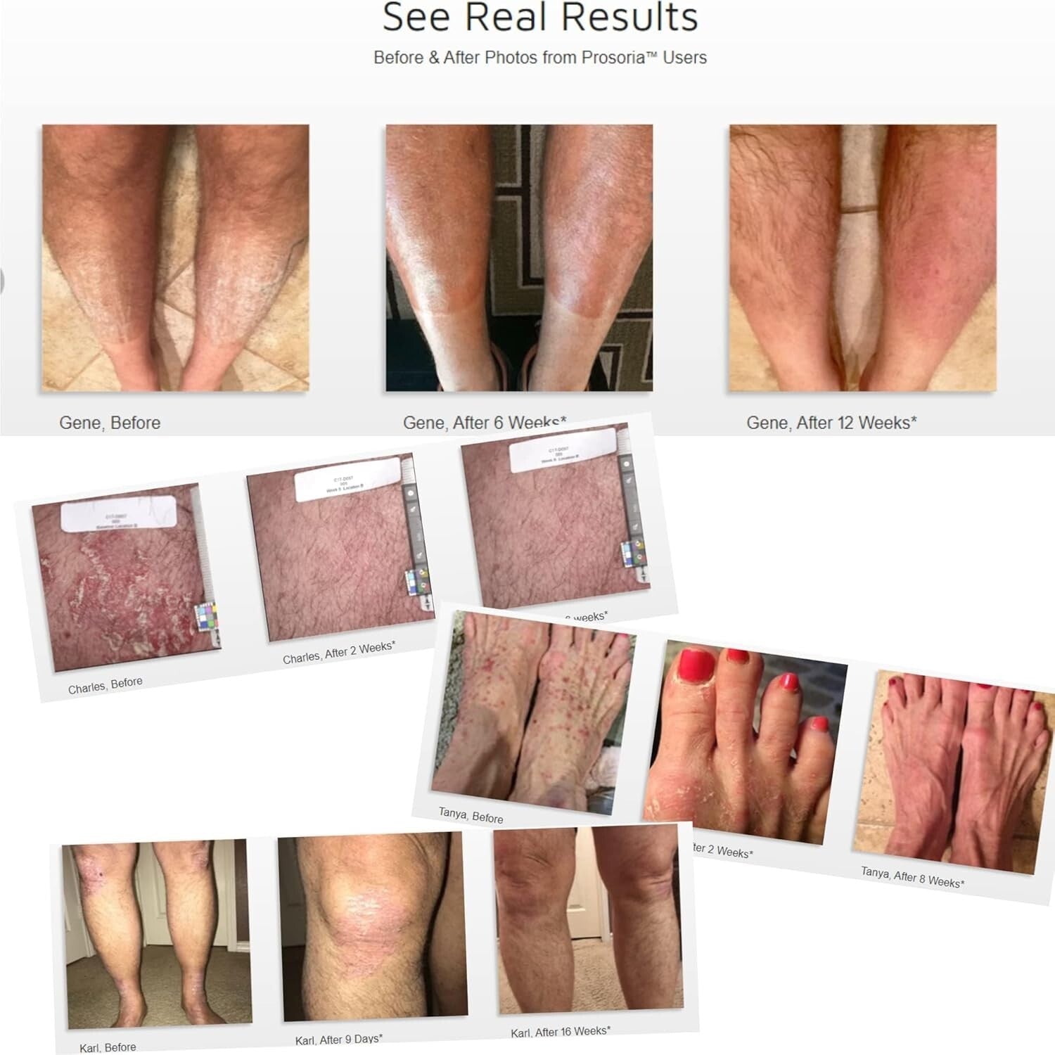 Dual Action Psoriasis Relief - 4 Bottles of Clinical Strength Exfoliating Care