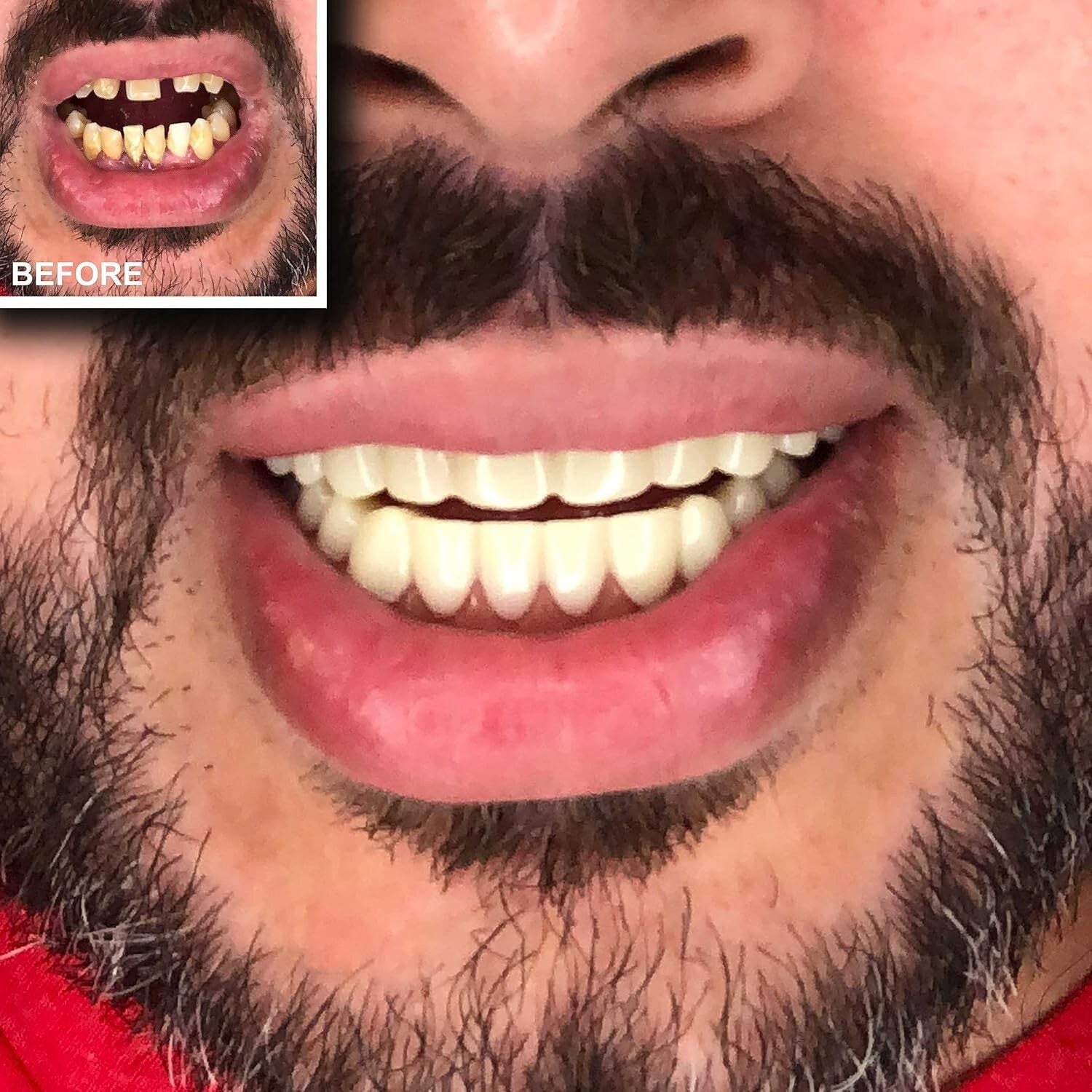 Comfortable Upper and Lower Press-On Veneers for Stunning Smile Transformation