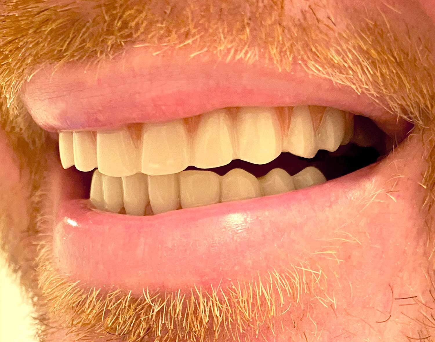 Comfortable Upper and Lower Press-On Veneers for Stunning Smile Transformation